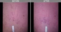 Chicago Vein Removal 